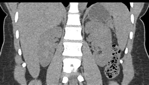 Oncocytoma Left Kidney - Kidney Case Studies - CTisus CT Scanning