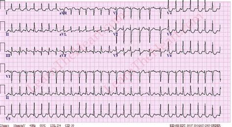 Các bất thường trên ECG: