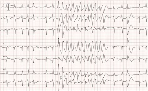 Taquicardia ventricular (TV): Criterios ECG, causas, clasificación ...