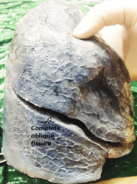 Right lung showing complete oblique fissure and absent horizontal ...