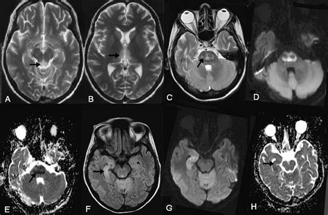 MRI | Hyponatremia and Central Pontine Myelinolysis