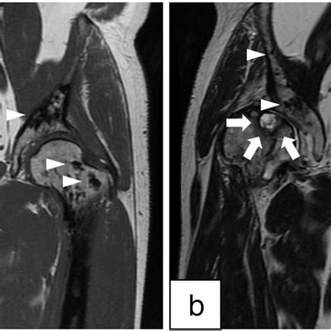 Coronal MRI of Both Hips. A subchondral cyst within the right femoral ...