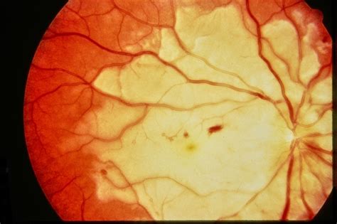 Purtscher's Retinopathy - Retina Image Bank