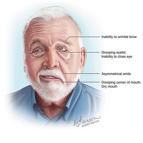 Facial Palsy - Barrow Neurological Institute