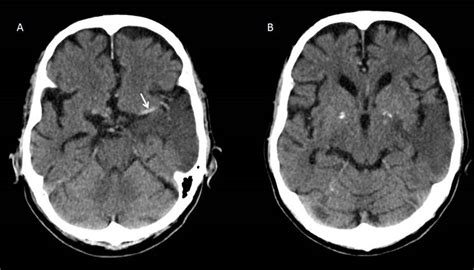 Dense MCA sign – Radiology Cases