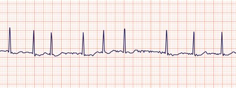 Atrial Fibrillation Vs Atrial Flutter Ecg