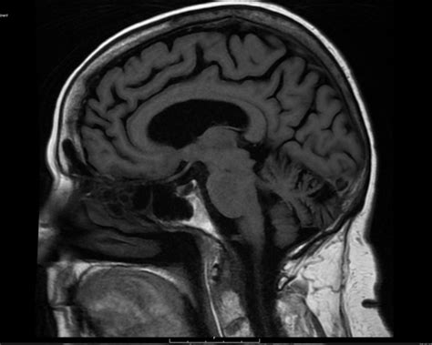 MRI Brain without Contrast - Greater Waterbury Imaging Center