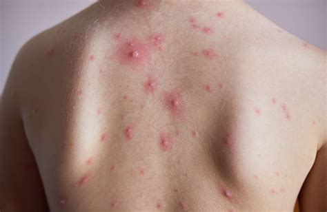 Chickenpox: Signs, Symptoms, and Complications