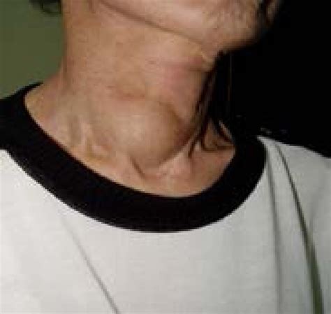 Riedel thyroiditis - Health Jade