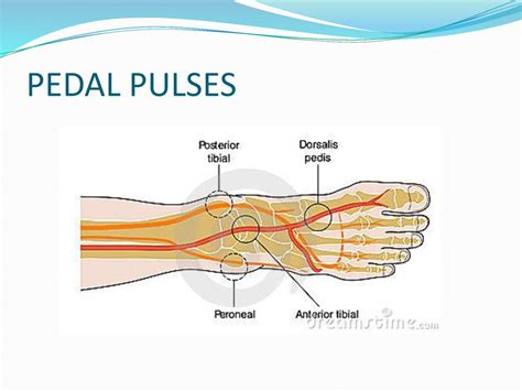 Assessing pedal pulses