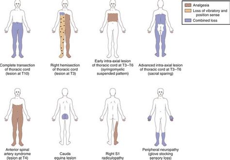 Paraplegia and Spinal Cord Syndromes | Neupsy Key