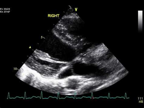 Persistent Left Superior Vena Cava echocardiography - YouTube