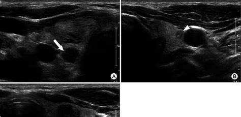 Type III thyroid metastases in a 55-year-old male with lung cancer ...