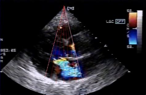 Basic Principles of Echocardiography and Doppler - BroadcastMed