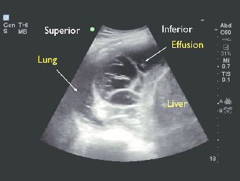 Pleural Effusion Lung Ultrasound