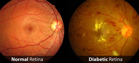 Diabetic Retinopathy