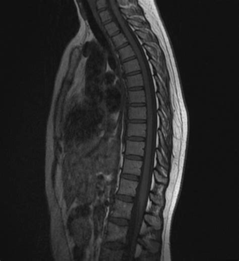 Normal thoracic spine MRI | Image | Radiopaedia.org