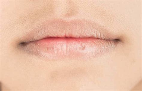 Eczema On Lips: Causes, Treatment Options, & Prevention Tips