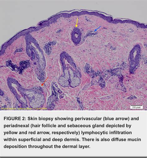 Figure 1 from Tumid Lupus Erythematosus and Systemic Lupus ...