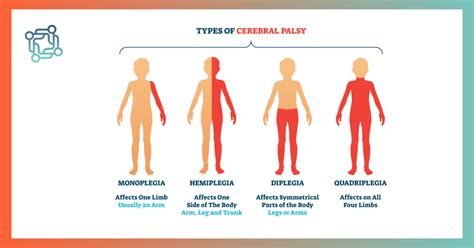 What is Spastic Diplegic Cerebral Palsy?