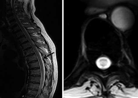 PARAPARESIA ESPASTICA TROPICAL PDF