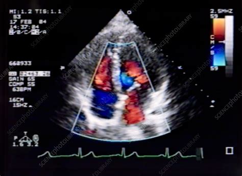 Doppler Echocardiogram of Heart - Stock Image - M406/0320 - Science ...