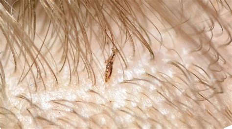 How To Check For Head Lice - Fatintroduction28