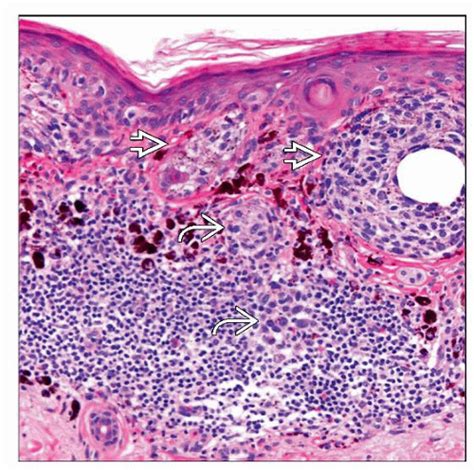 Lentigo Maligna Histology