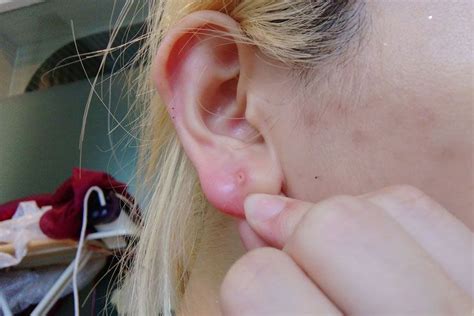 Tips to Get Rid of Pimple in Earlobe