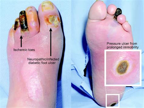 Chronic wound, causes, symptoms, diagnosis & treatment