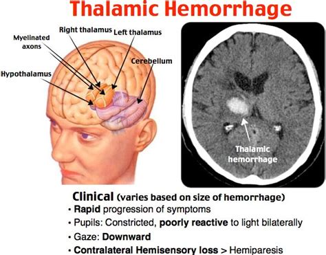 Rosh Review | Medical knowledge, Emergency medicine, Neurology