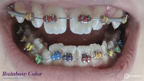 Colored Braces | Modern Orthodontics on Sammamish Plateau