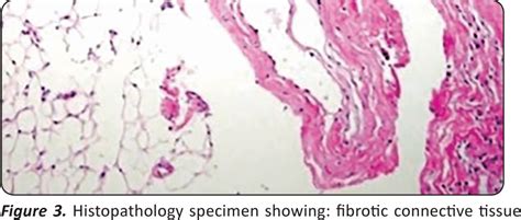 [PDF] Ligamentum Flavum Cyst in the Lumbar Spine: A Case Report ...