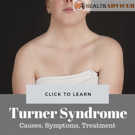 Turner Syndrome: Causes, Picture, Symptoms And Treatment