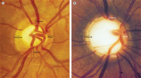 Glaucoma - The Lancet