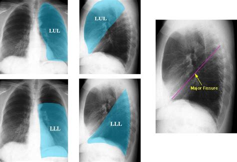 Pin by Stelios Daskalogiannis on THORAX | Lung lobes, Lung anatomy ...