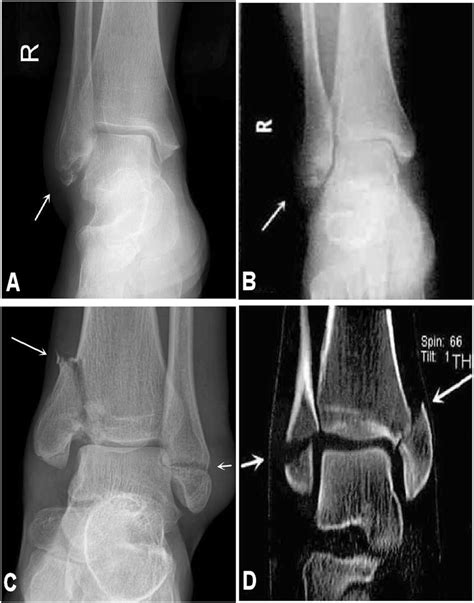 Medial Malleolus Fracture Splint