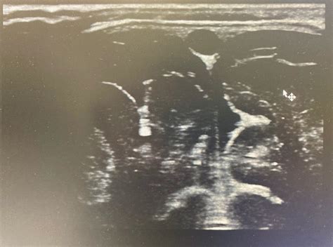 Surface ultrasound of the anterior fontanelle. No laceration of the ...