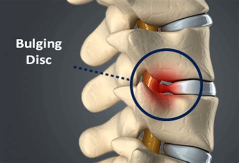 broad based disc herniation treatment - tameka-hope