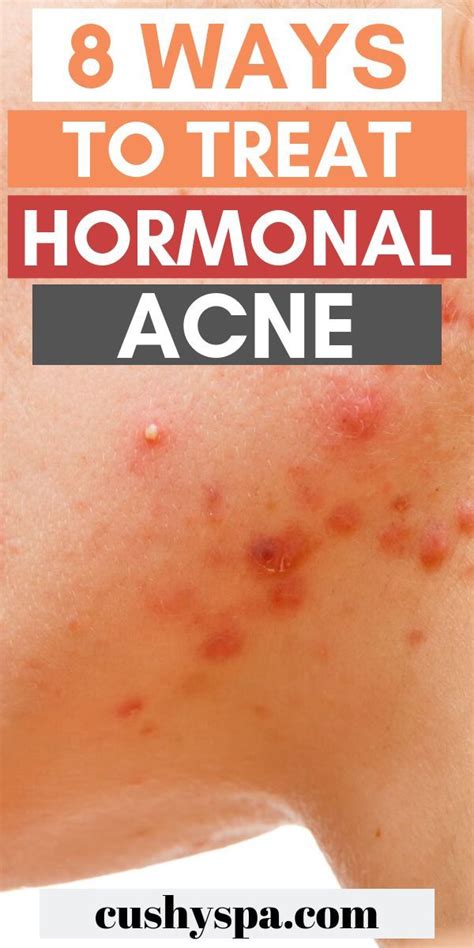 Hormonal acne can be so frustrating to deal with. Try these natural ...