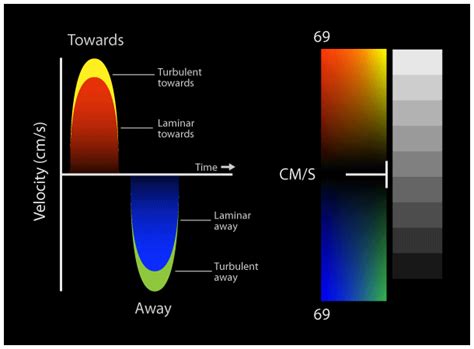 Image result for aliasing in color flow imaging Ultrasound Physics ...