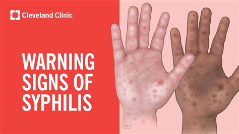 Stages Of Syphilis Infection