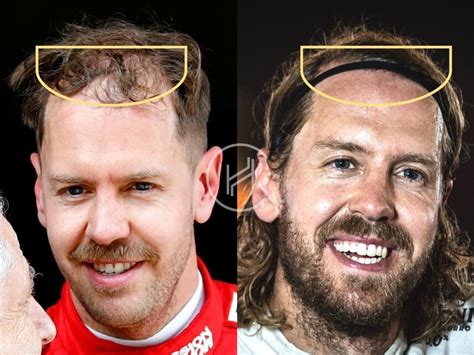 Sebastian Vettel Hair Transplant - Hair Loss & Technical Analysis