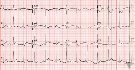 Posterior Myocardial Infarction | ECG Stampede