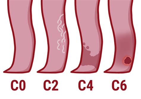 CEAP Classification of Venous Insufficiency: What is it? - Delaware ...