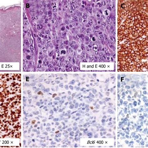 Histological and immunohistochemical features of the diffuse large B ...