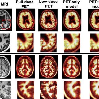 Example of simulated 1% amyloid PET/MRI imaging in a patient with a a ...