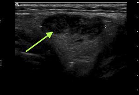 Lipoma Ultrasound Treatment - Infoupdate.org