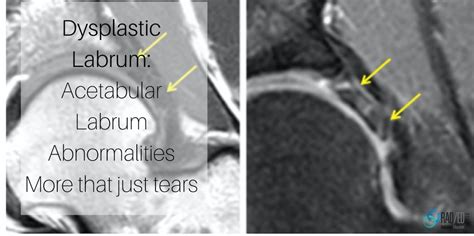 Hip Dysplastic Labrum MRI: Acetabular Labrum More than just tears Part ...