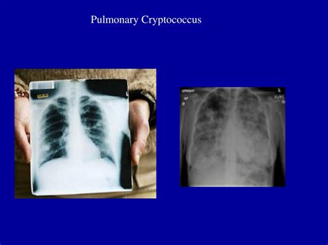 PPT - Cryptococcus neoformans and other Yeast PowerPoint Presentation ...